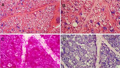 Recommendations for Infantile-Onset and Late-Onset Pompe Disease: An Iranian Consensus